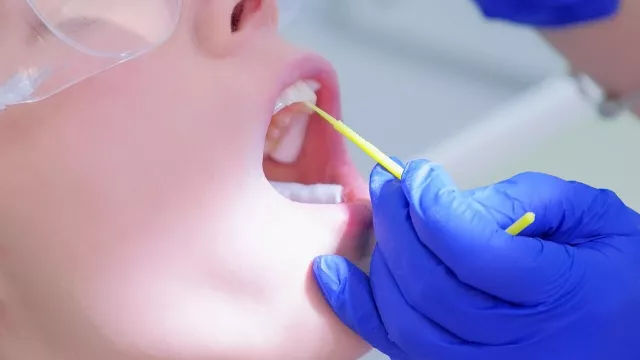 Fluoridierung zur Härtung des Zahnschmelzes