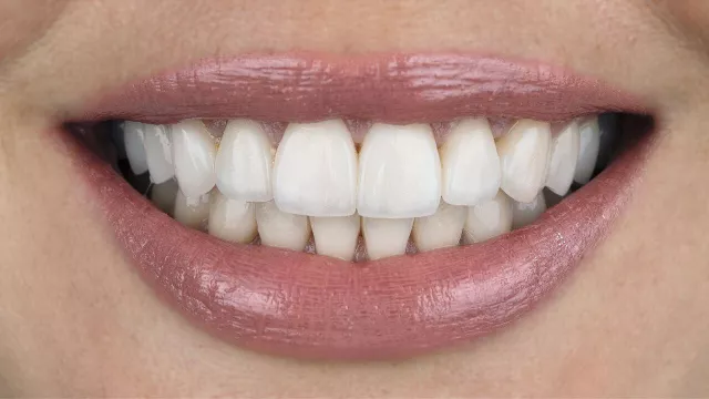 Zähne nach der Behandlung mit Veneers