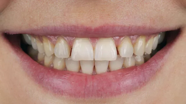 Zähne vor der Behandlung mit Veneers