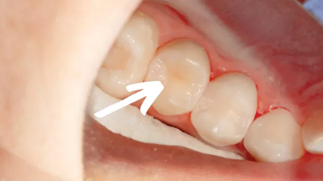 "Unsichtbare" Komposit-Füllung in einem kleinen Backenzahn "Unsichtbare" Komposit-Füllung in einem kleinen Backenzahn
